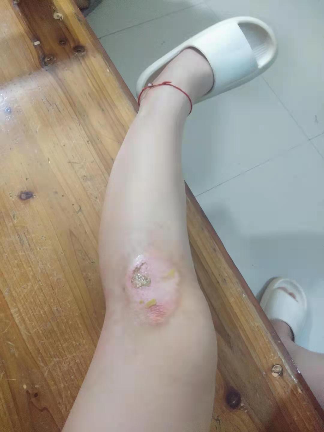 骑车摔倒擦伤怎么快速修复啊