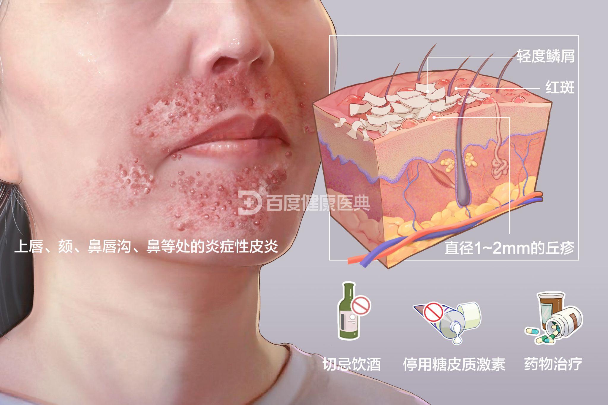 口周皮炎病人的饮食忌嘴都有哪些? - 知乎
