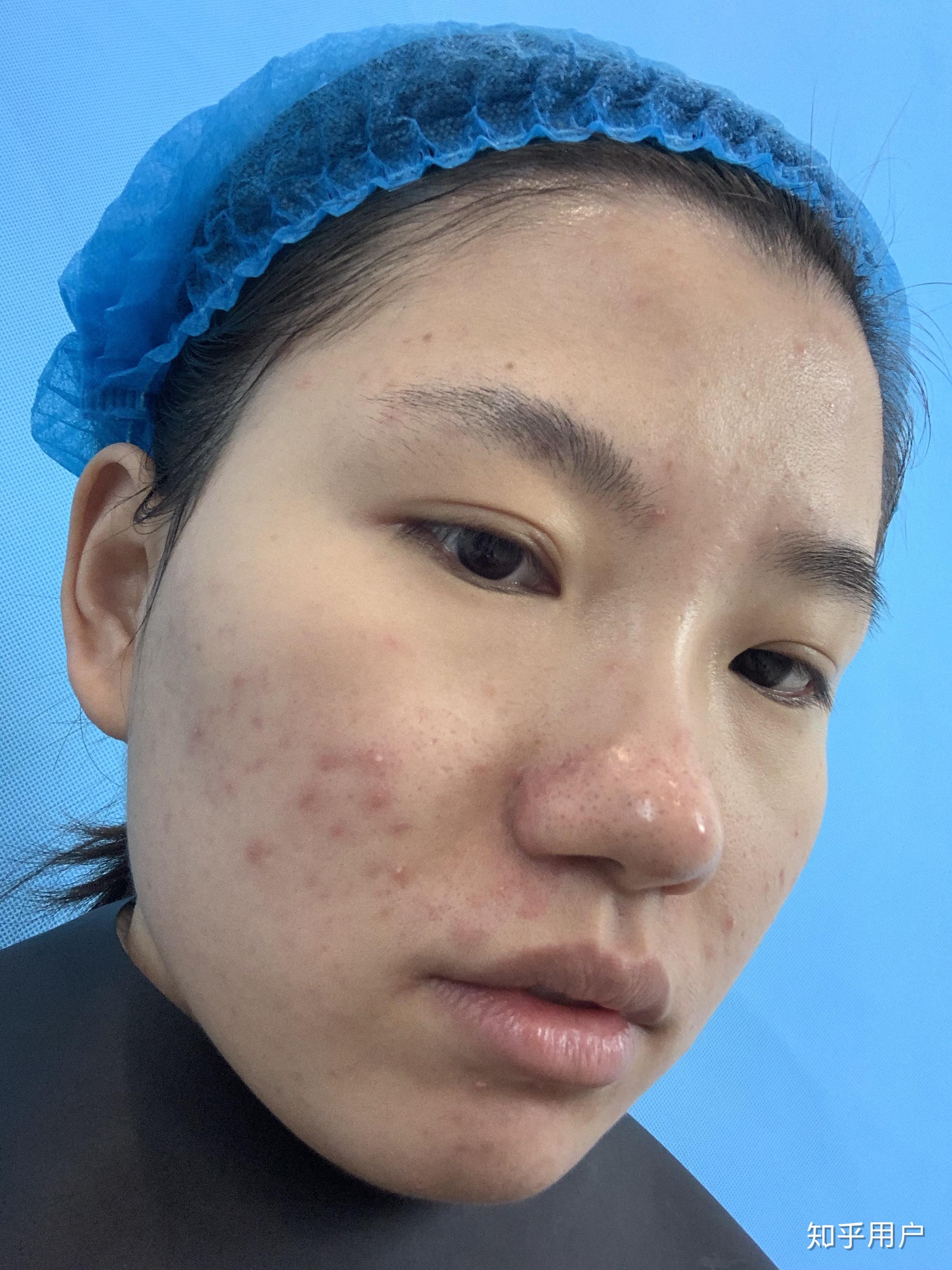 女孩子有酒糟鼻是什么样的体验?