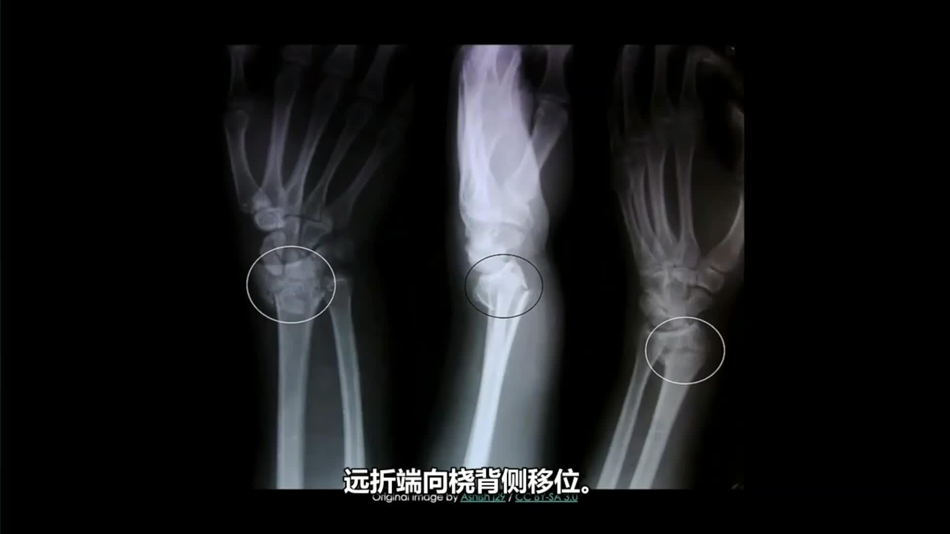桡骨远端骨折的伸直型骨折(Colles骨折和屈曲型骨折(Smith骨折)这俩的x线片移位特点咋记呀? - 知乎