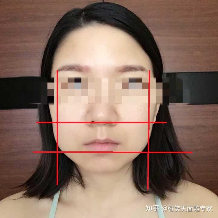 求大神指点这种脸型是否属于下颌骨肥大?打廋脸针的话效果明显吗?