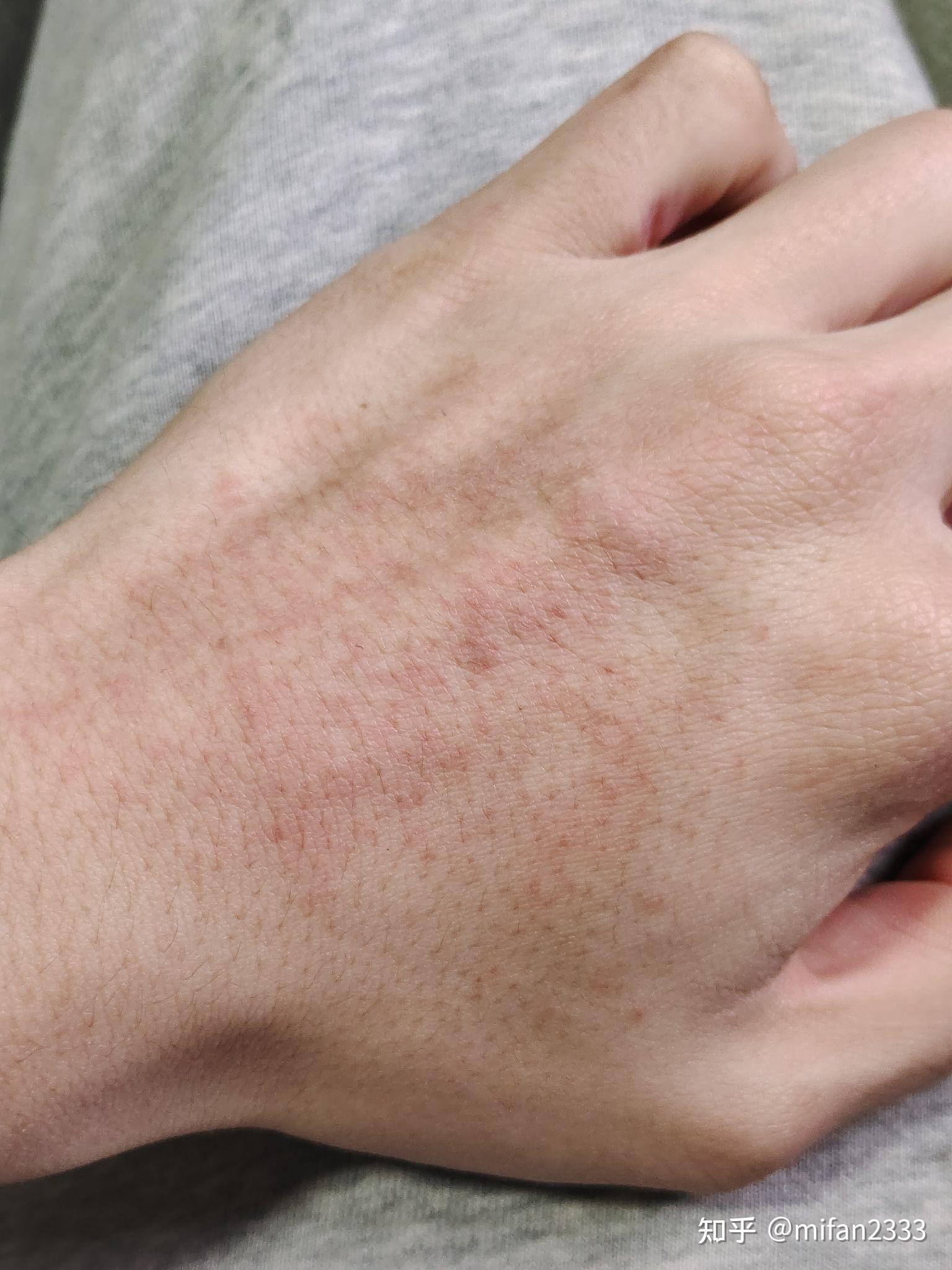 吃了异维a酸一个月后,手上起红疹子,刚开始长,还不是特别严重,但是有