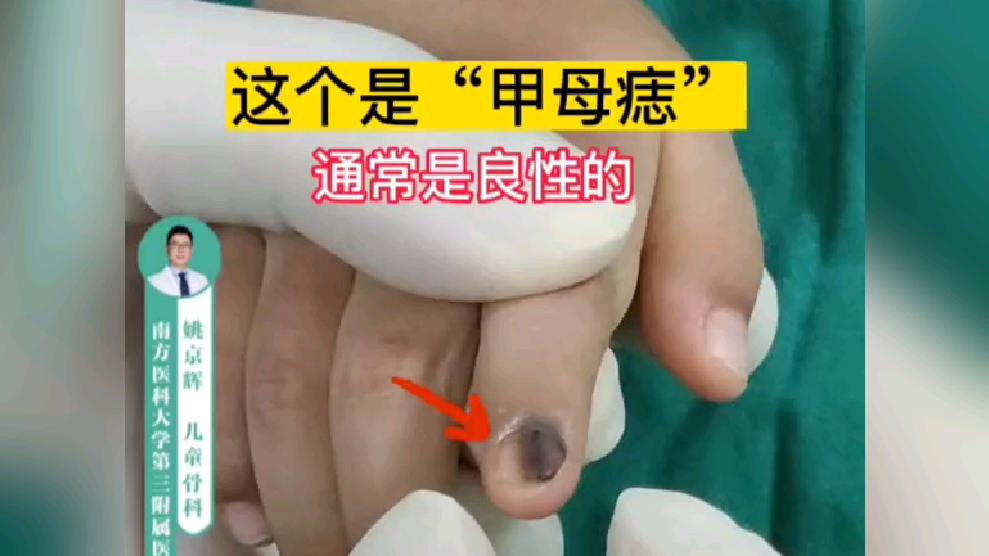 甲母痣皮肤镜图片