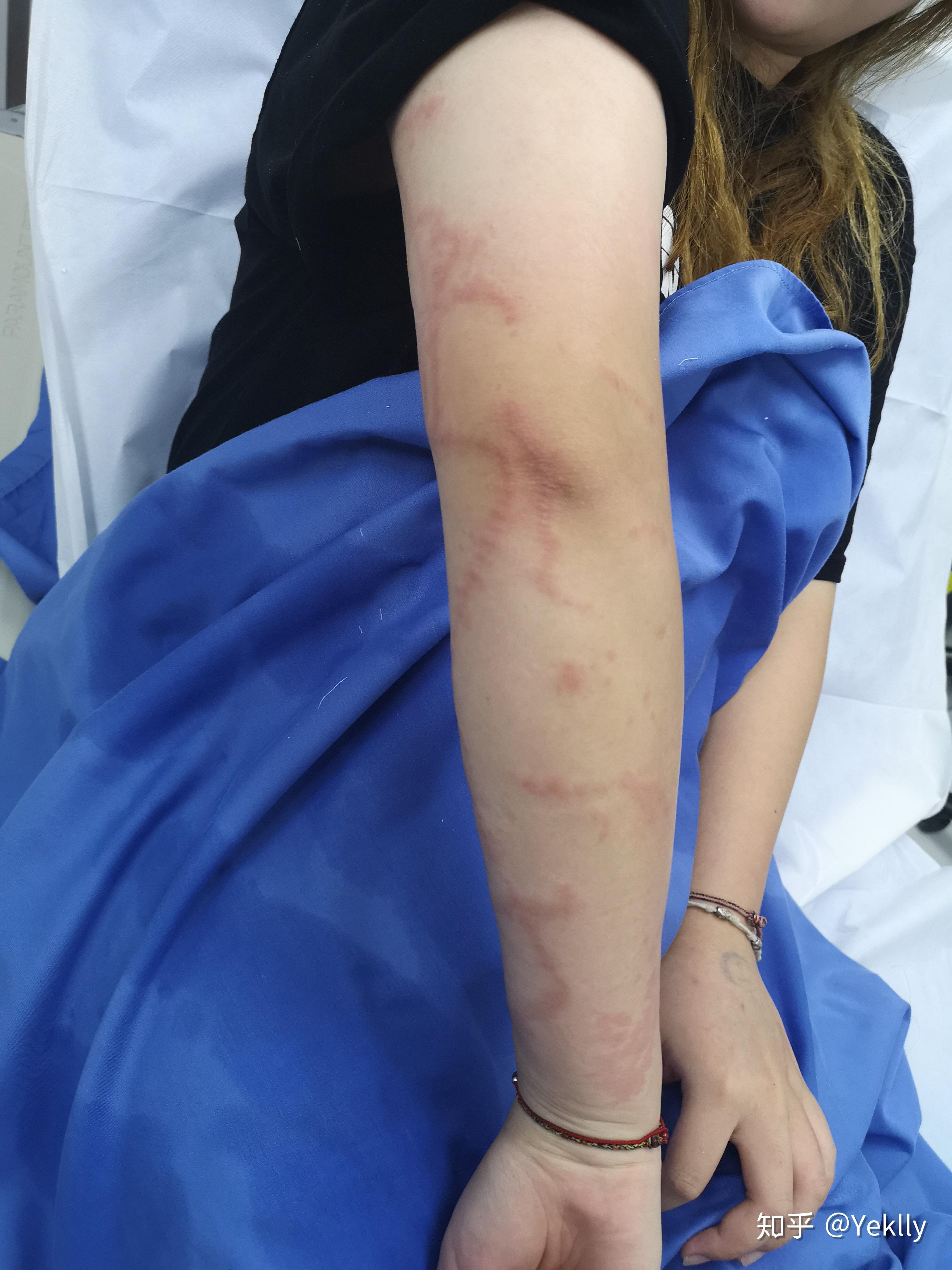 被水母蛰是一种什么体验