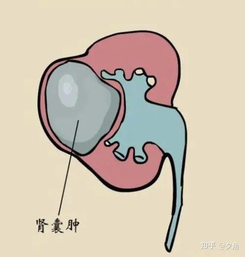 肾囊肿常见的症状有哪些