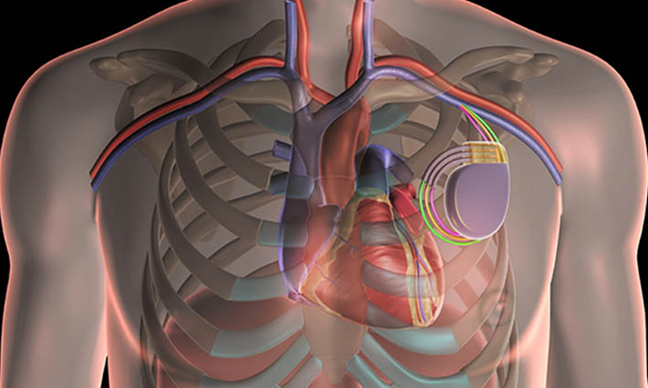 起搏器位置图片图片