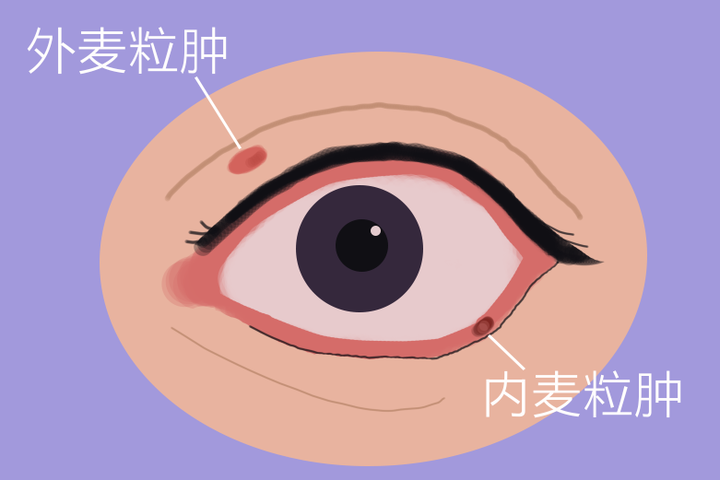 为什么眼睛会长麦粒肿？ - 知乎