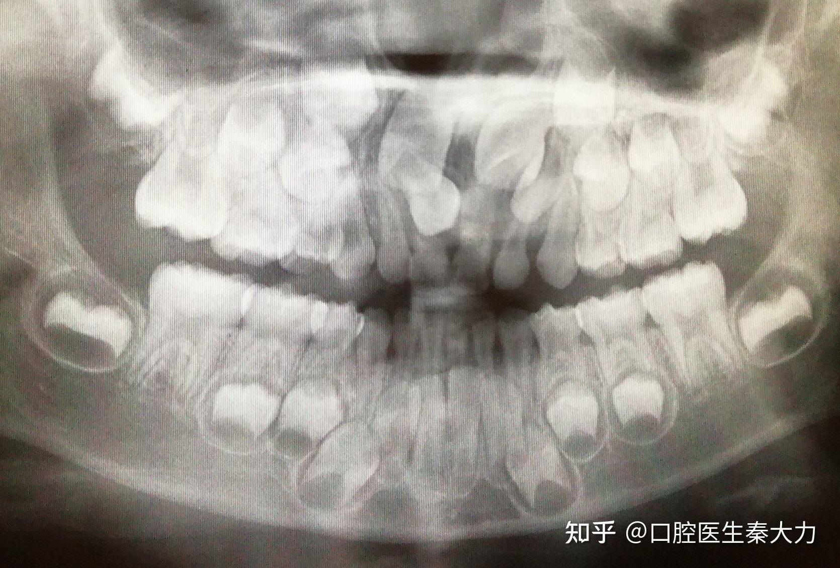 关于多齿症是真的吗？ - 知乎