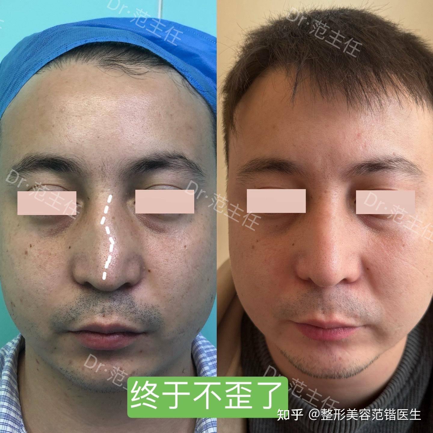 歪鼻子矫正