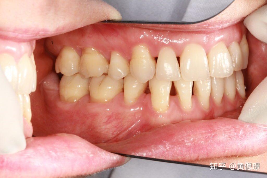 黑三角牙齿案例图片