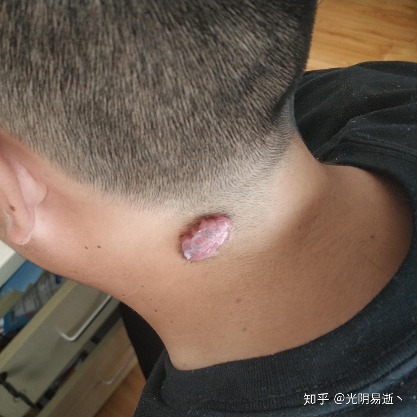 瘢痕体质的人这一生有什么样的体验? - 知乎