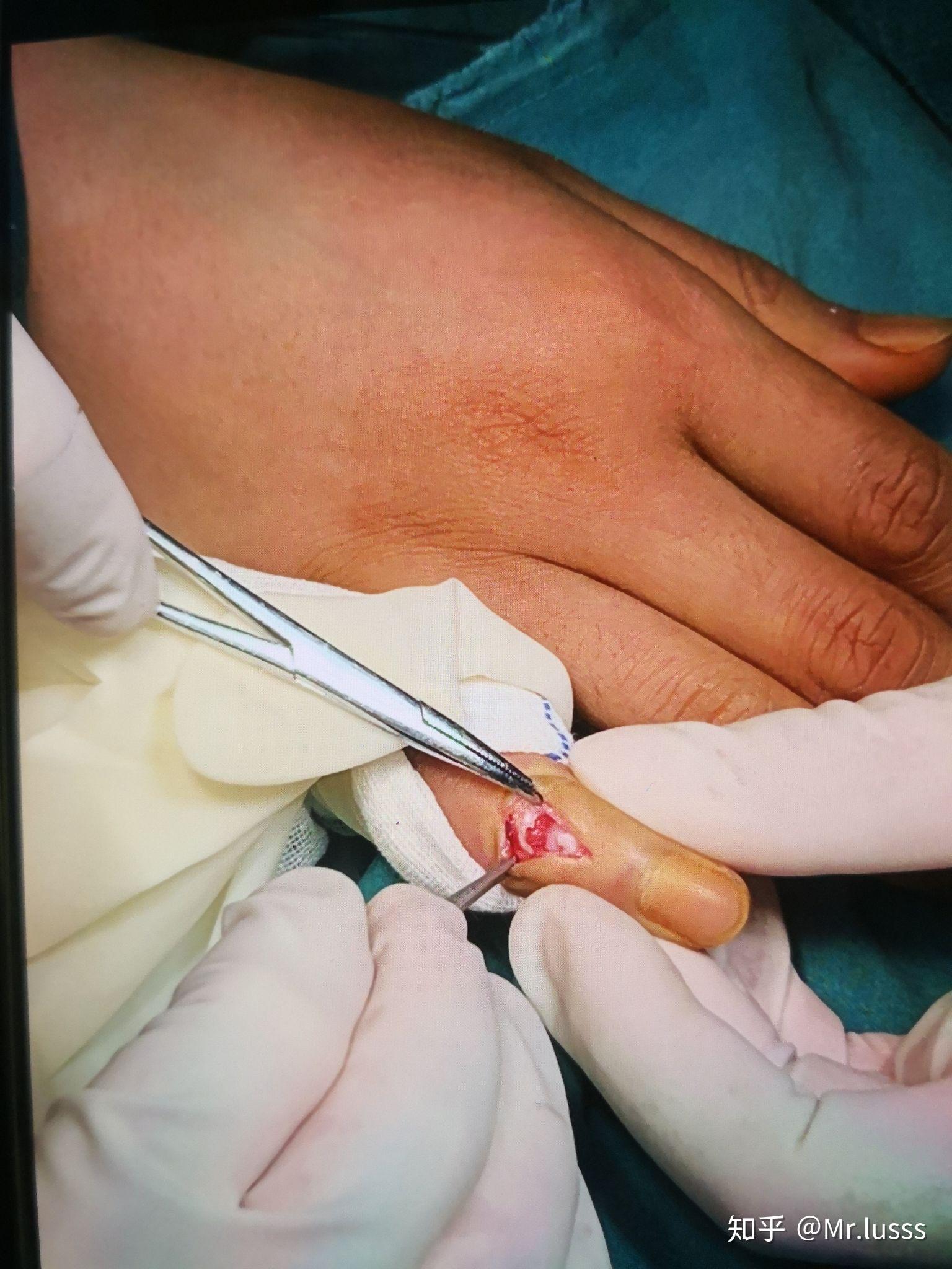 打篮球时手指戳伤不能伸直,求有经验的大神告诉我这是否严重啊!