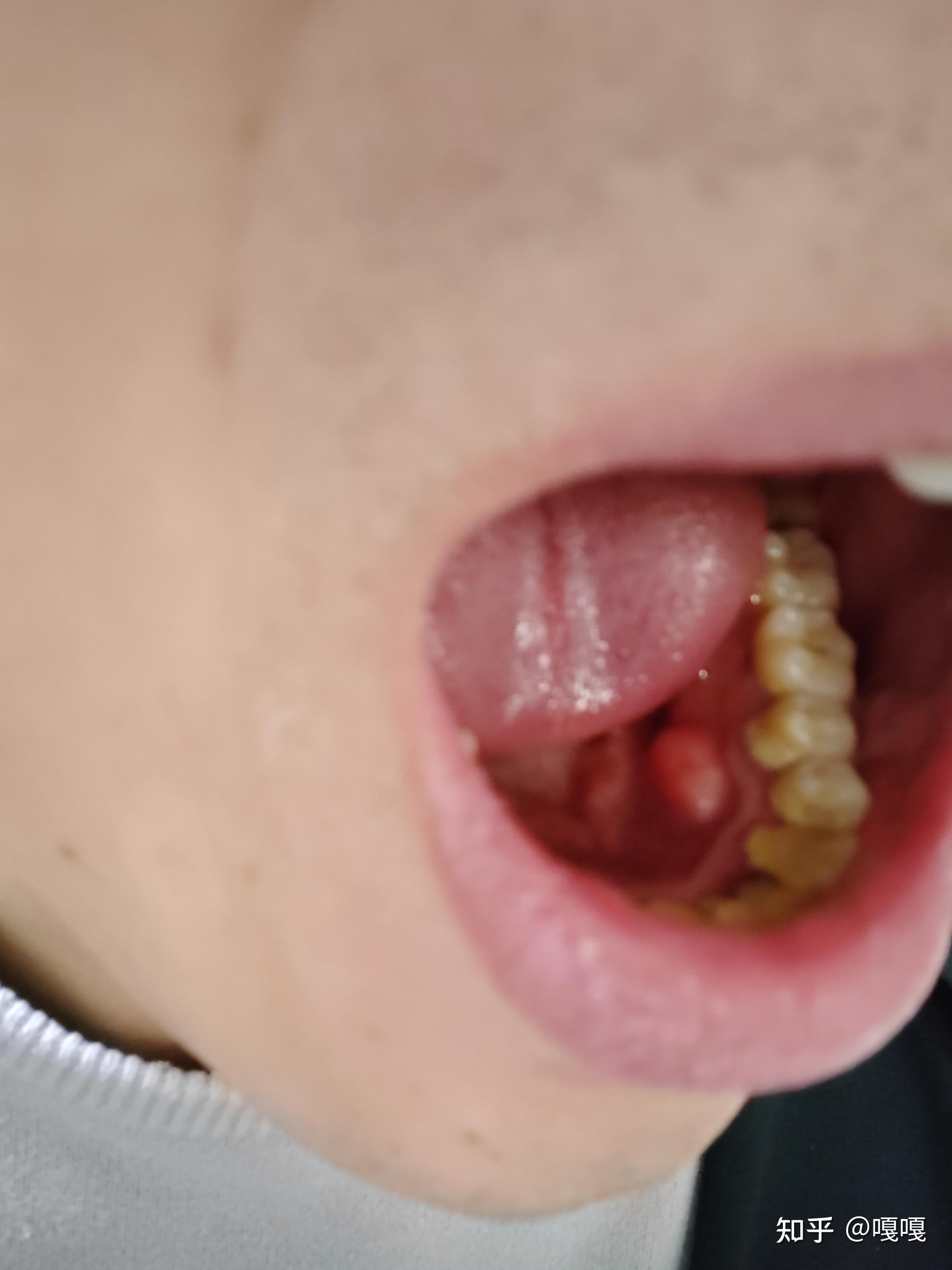 口腔下牙床内侧有一个硬的疙瘩,这是什么东西? 