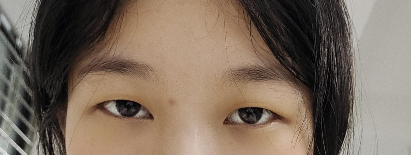 眼睛一高一低还有救吗