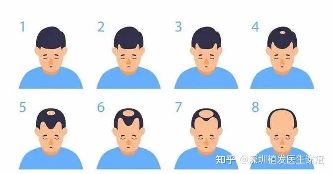 脱发掉发严重到秃成“地中海”,头发还能长回来吗 - 知乎