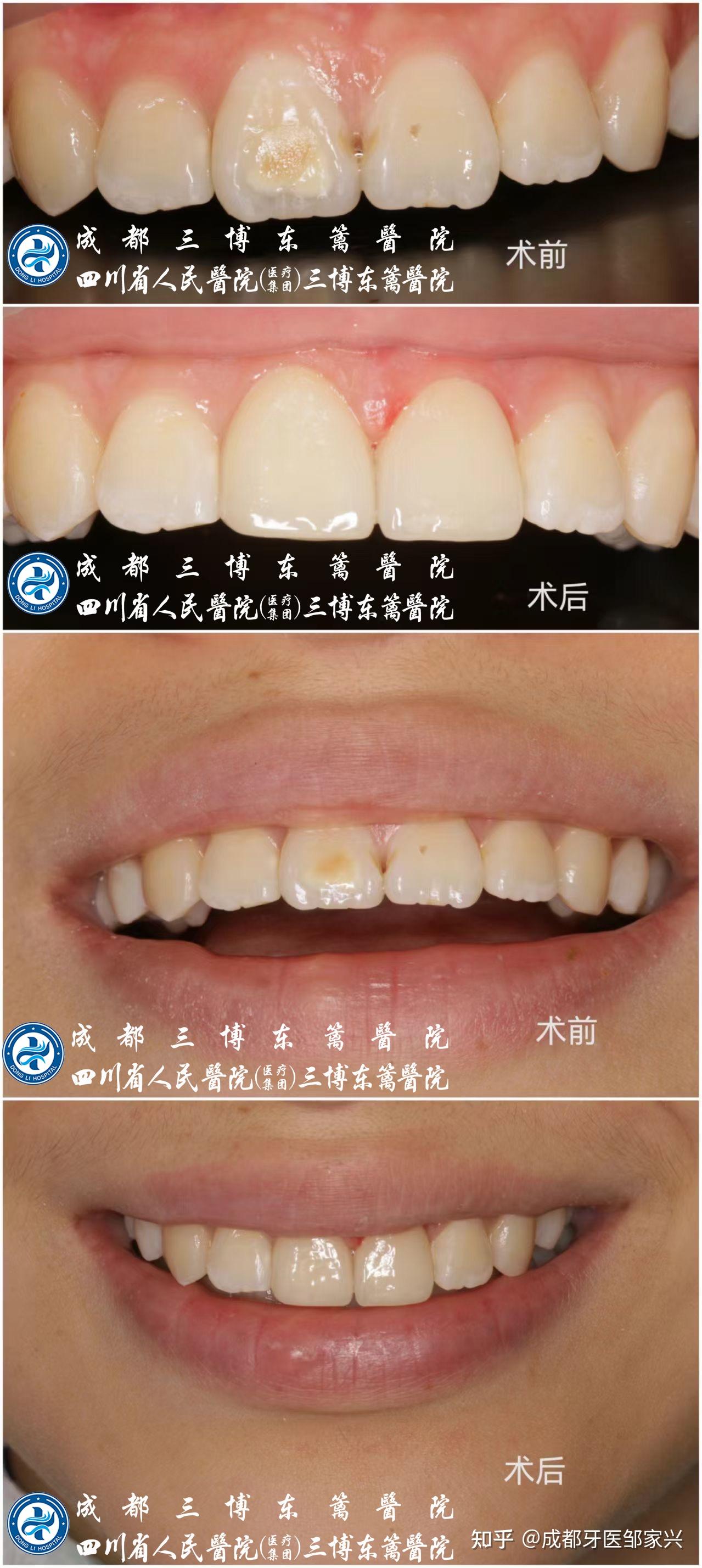 补牙 一般情况多少钱一颗? - 知乎