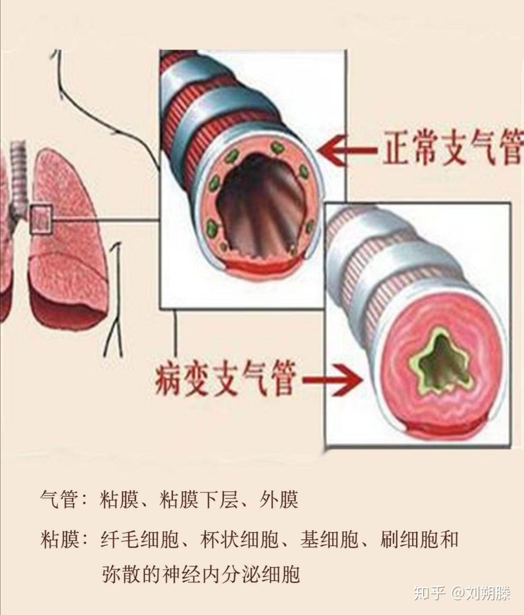 急性支气管炎一般多久好? - 知乎