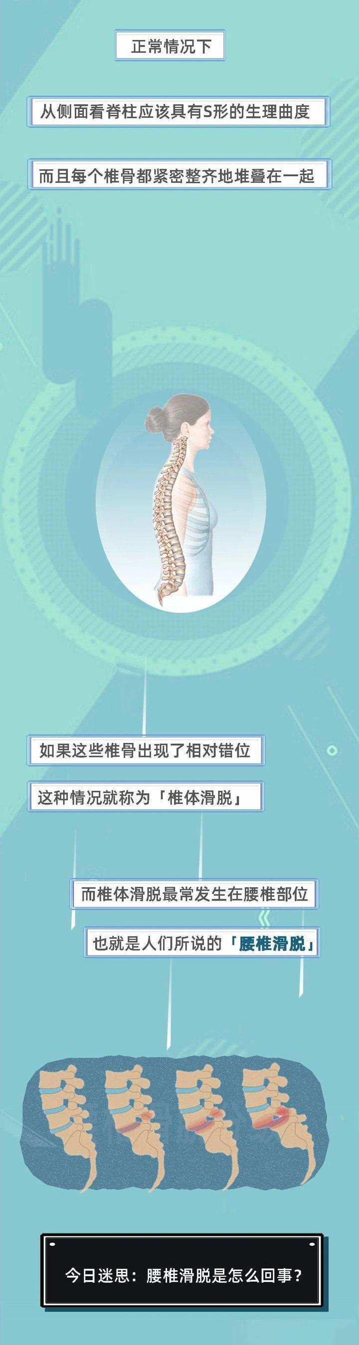 腰椎滑脱有哪些靠谱的治疗方案
