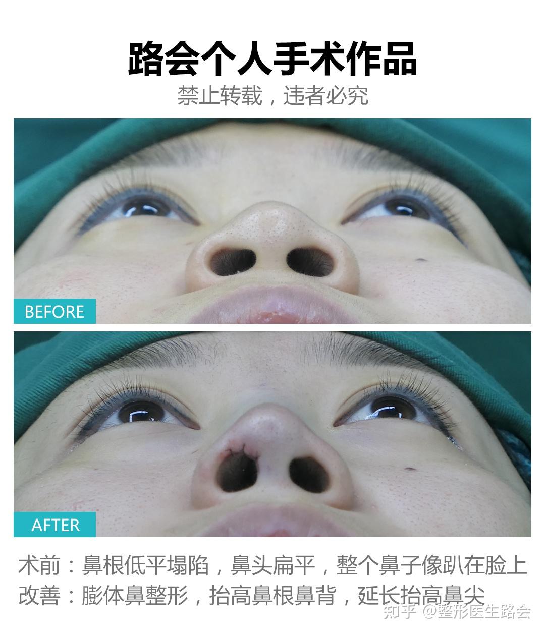 上海膨体隆鼻案例分享丨塌鼻子变成高挺鼻，让我的脸瞬间立体感十足！ - 知乎