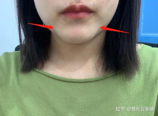 颏成型后为啥下巴这么怪呢? - 知乎