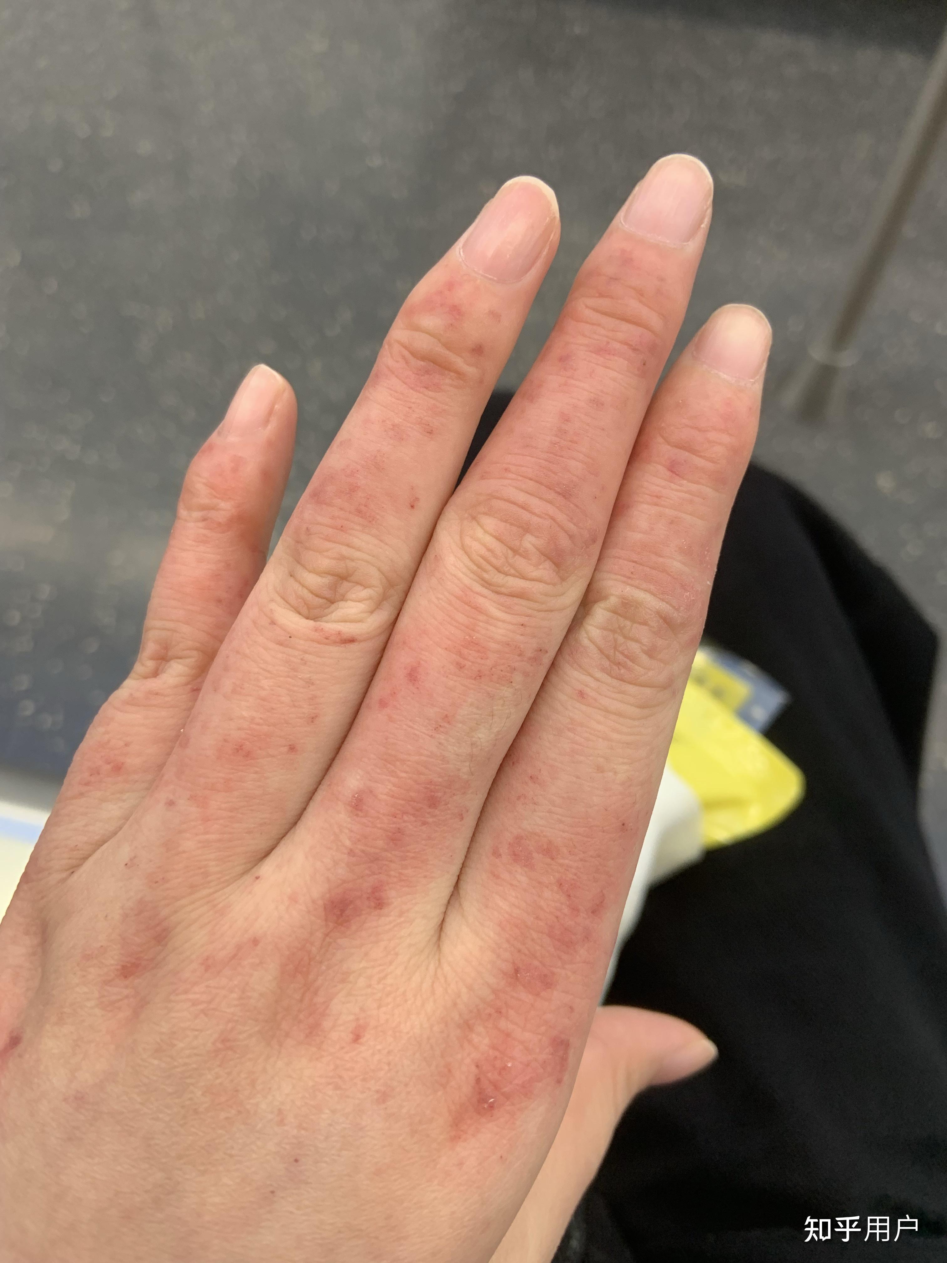 手上因为冻疮长的这些红疙瘩到底是什么东西?好多年都没有消掉.