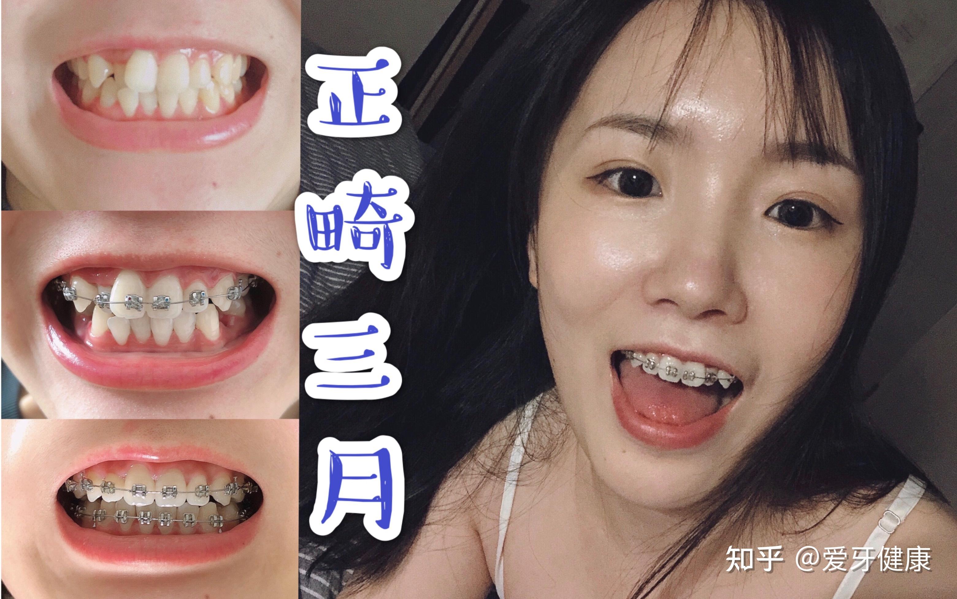 戴牙套的优缺点是什么?