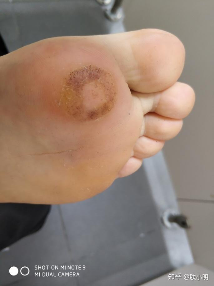脚底跖疣做了激光伤口旁出现很多皮下小红点是复发还是过敏啊