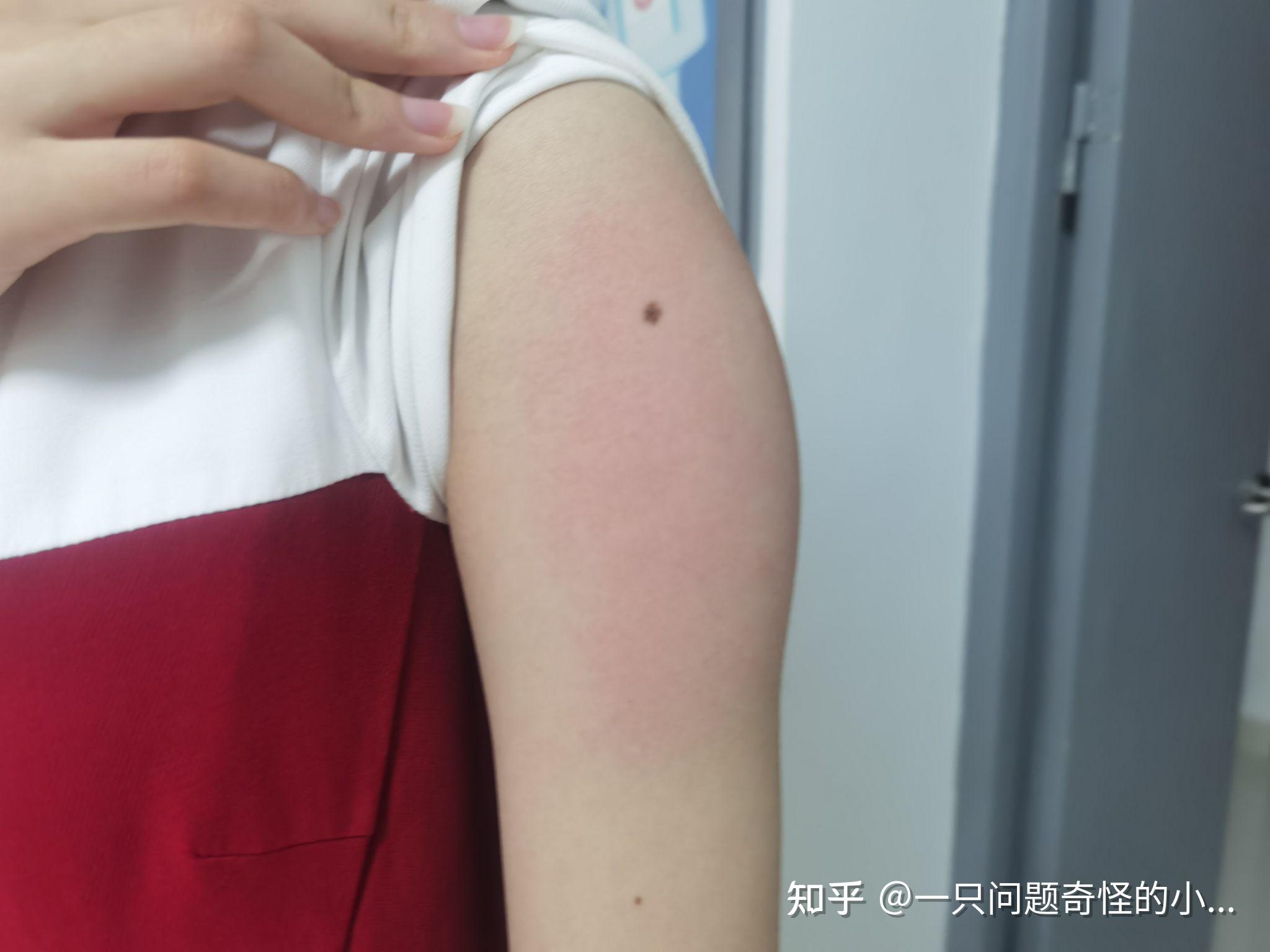 有朋友们接种完新冠疫苗胳膊肿了的嘛? - 知乎