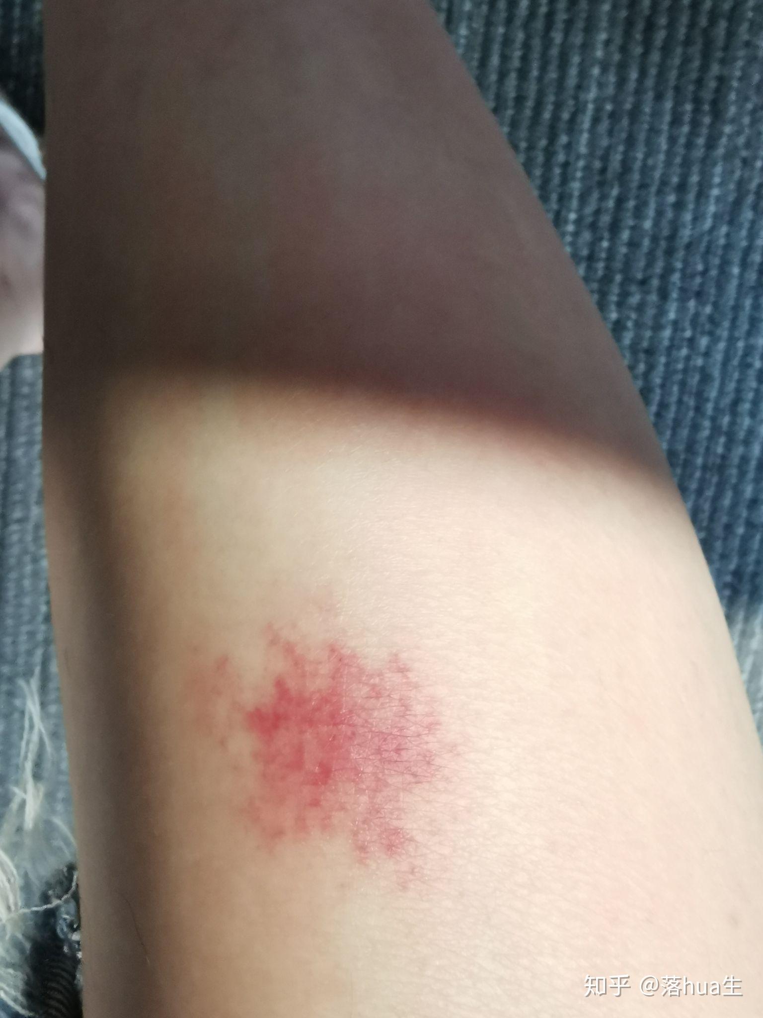 为什么我被蚊子咬了之后皮肤会变成类似淤青的紫红色,消退的很慢,肿的