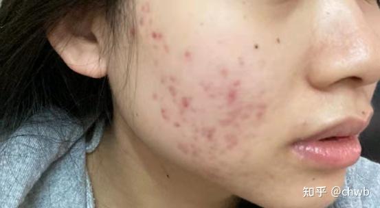 这个小东西能直接让你的痘印离家出走!