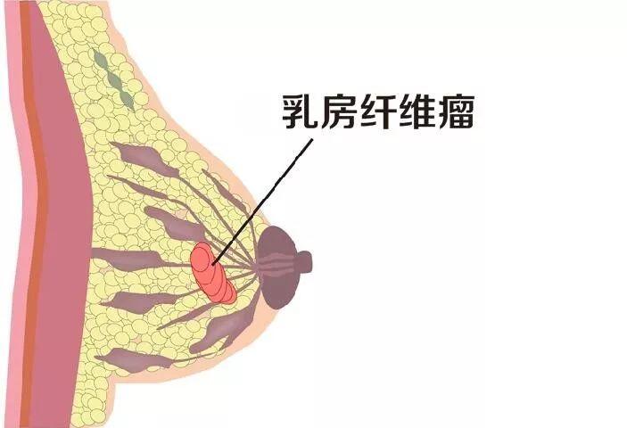 得了乳腺纖維腺瘤怎麼治好