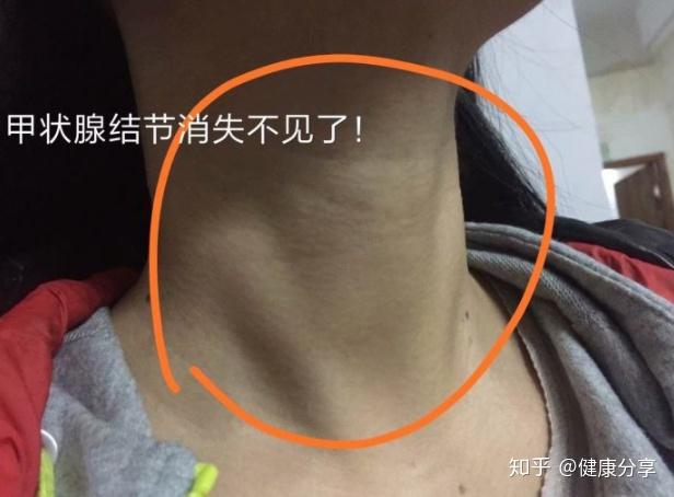 得了桥本氏甲状腺炎和甲状腺结节没有治疗方法只有等么? - 知乎