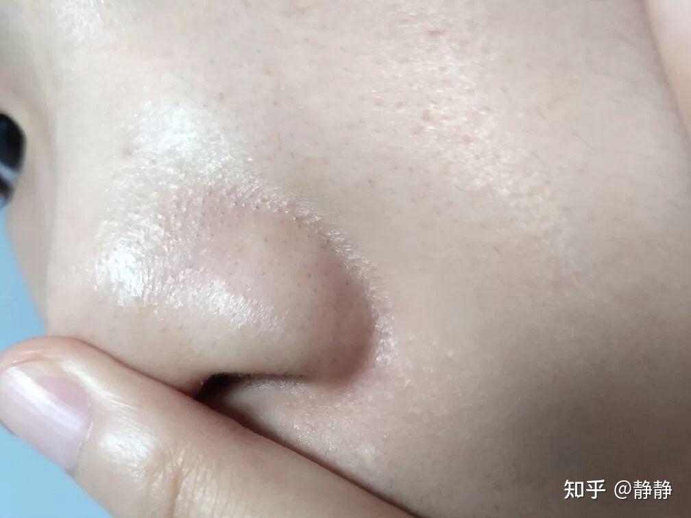 黑头大到直接挤出来是什么感受