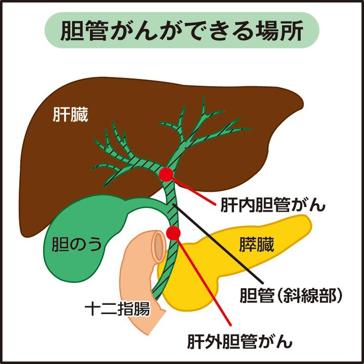 胆管癌会出现哪些症状？ - 知乎