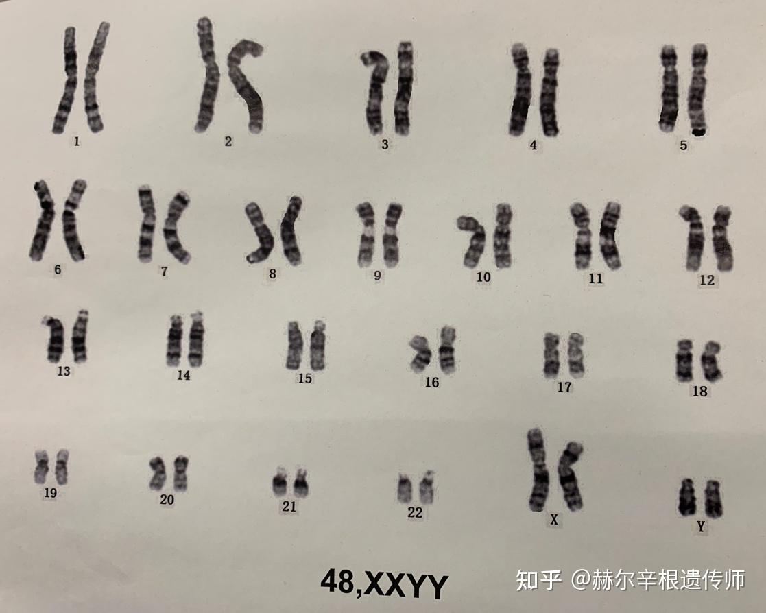 XXY染色体人的特征图片