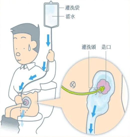 肠造口灌洗操作步骤 - 知乎