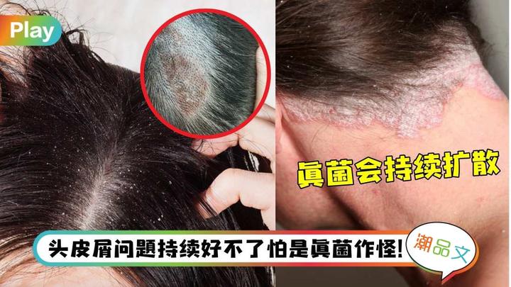 《科普》头皮屑像雪花那么多?原来是头皮真菌感染在作怪! - 知乎