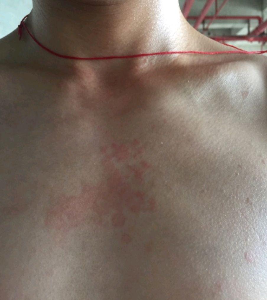 艾滋病急性期皮疹第一次出现在四肢吗?