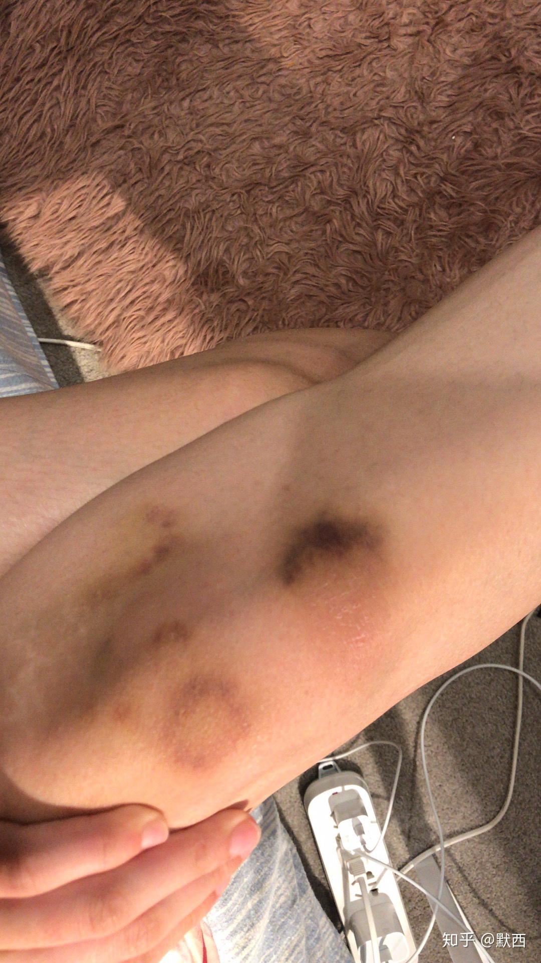 身上总会莫名其妙起淤青是什么原因