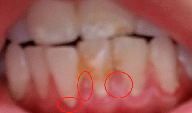 牙齿上有黄斑? - 知乎