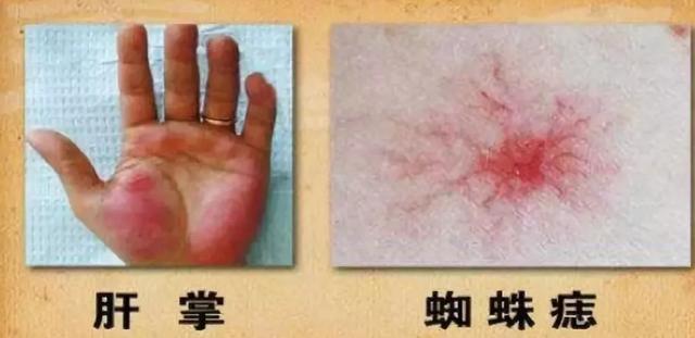 蜘蛛痣和肝掌是怎么回事? - 知乎