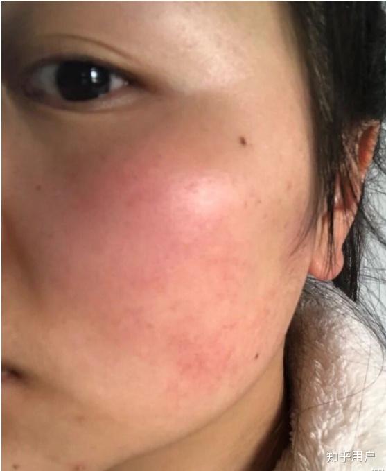 角质层薄应如何修复