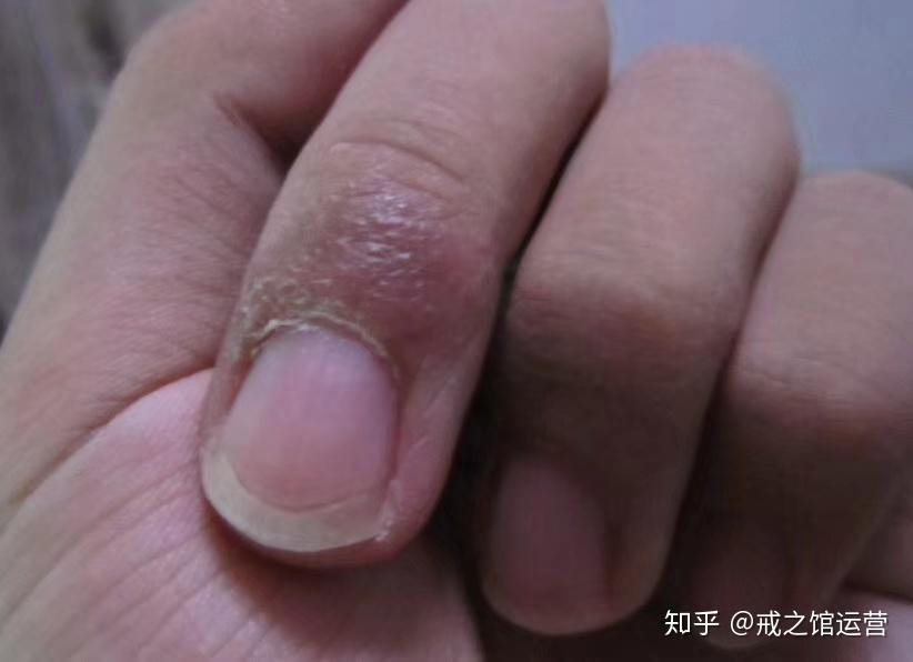 汗疱疹的症状有哪些 - 知乎