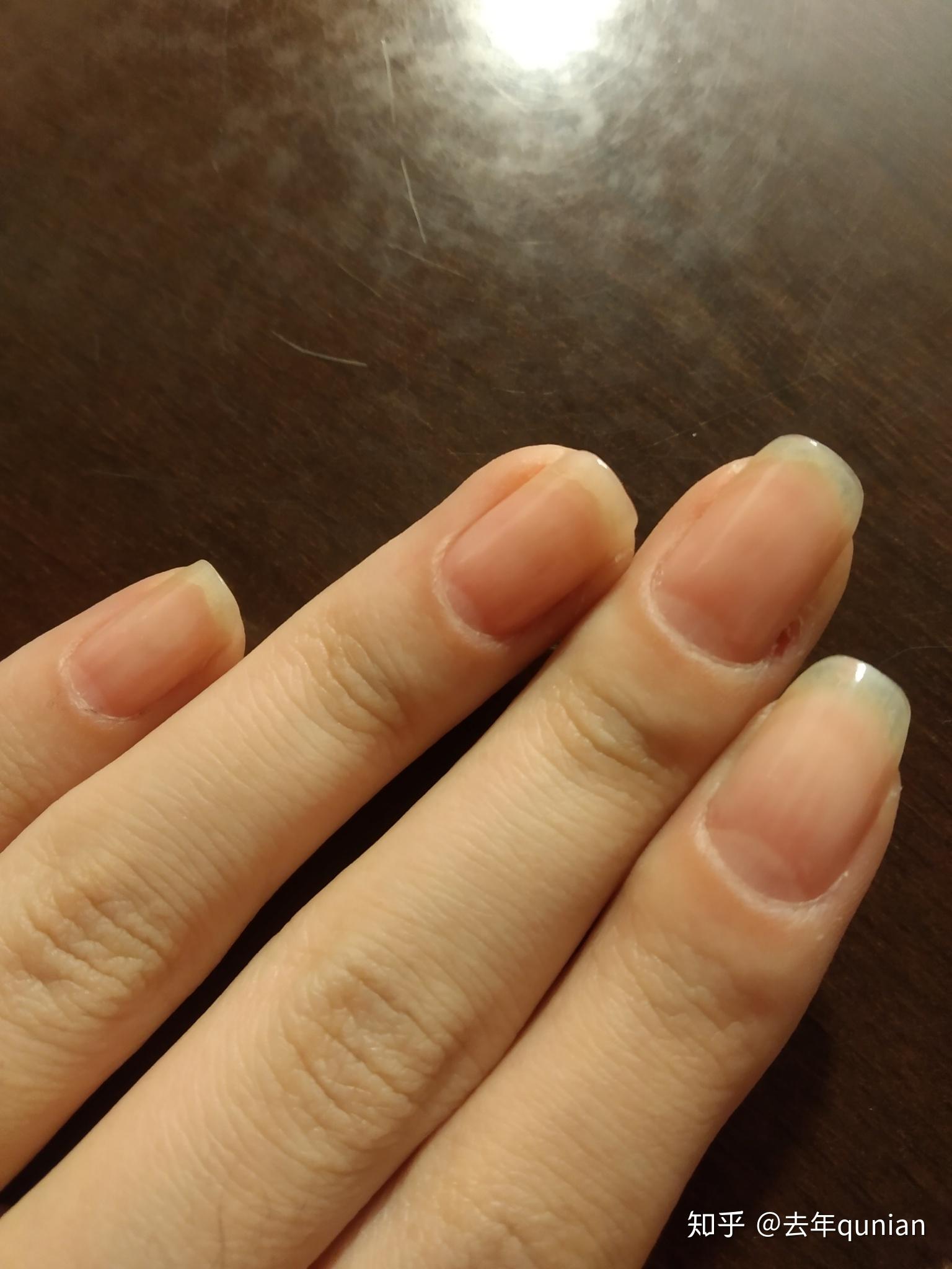 甲床过短应该如何变长