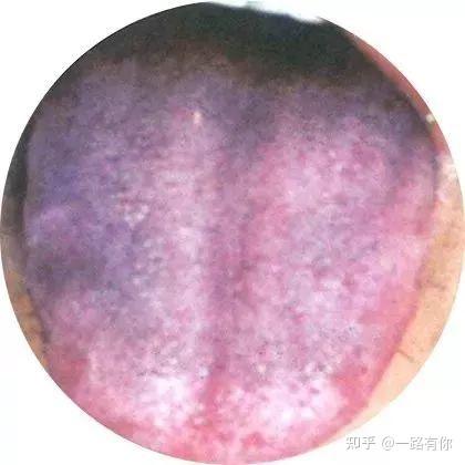 最全的舌诊图谱,附治疗方案,建议收藏 - 知乎