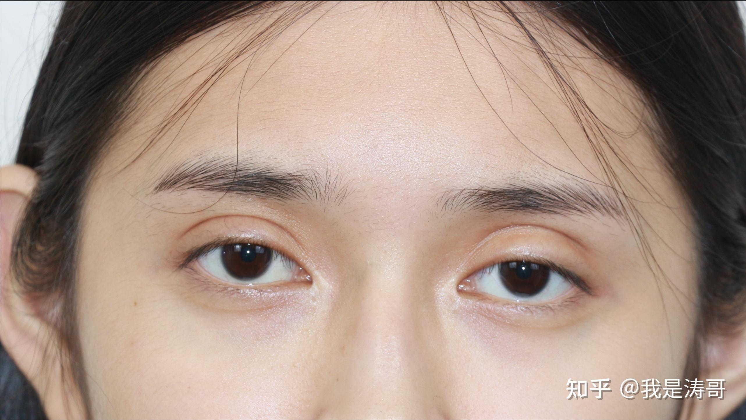 双眼皮修复中宽改窄为什么更难? - 知乎