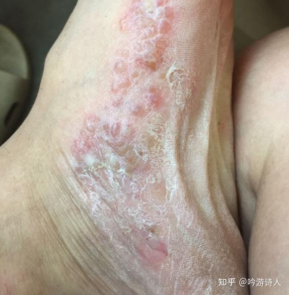 脚上长水泡很痒还脱皮怎么办啊? - 知乎