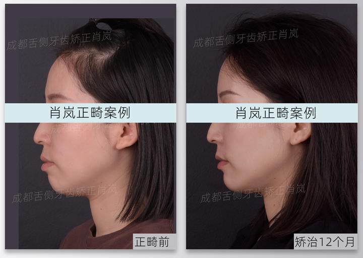 成都牙齿矫正|舌侧正畸|隐形矫治12个月侧貌改善 - 知乎