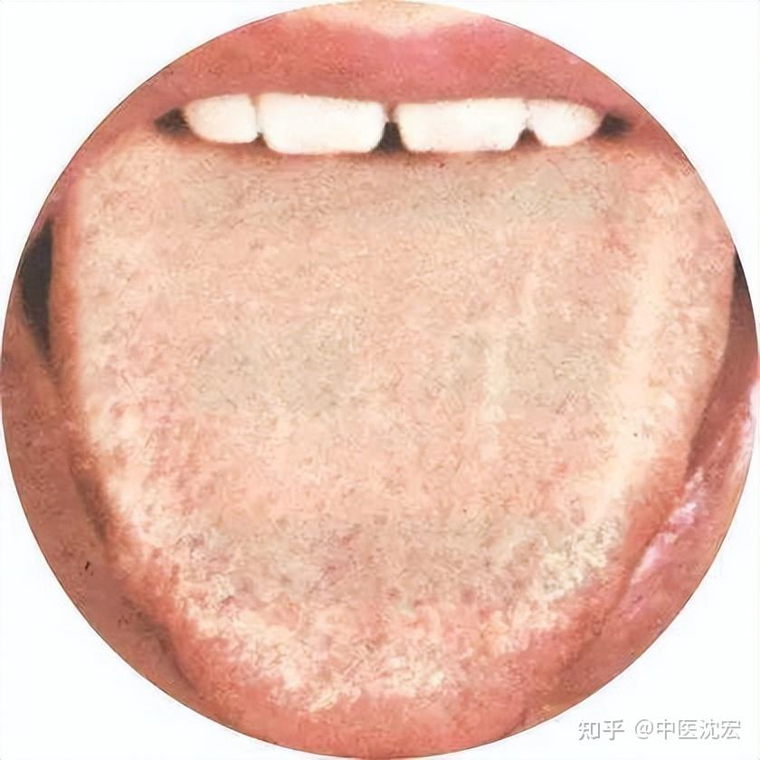 肾虚不虚,哪里虚,看舌头就知道,一招教你分清阴虚、阳虚、精虚 - 知乎