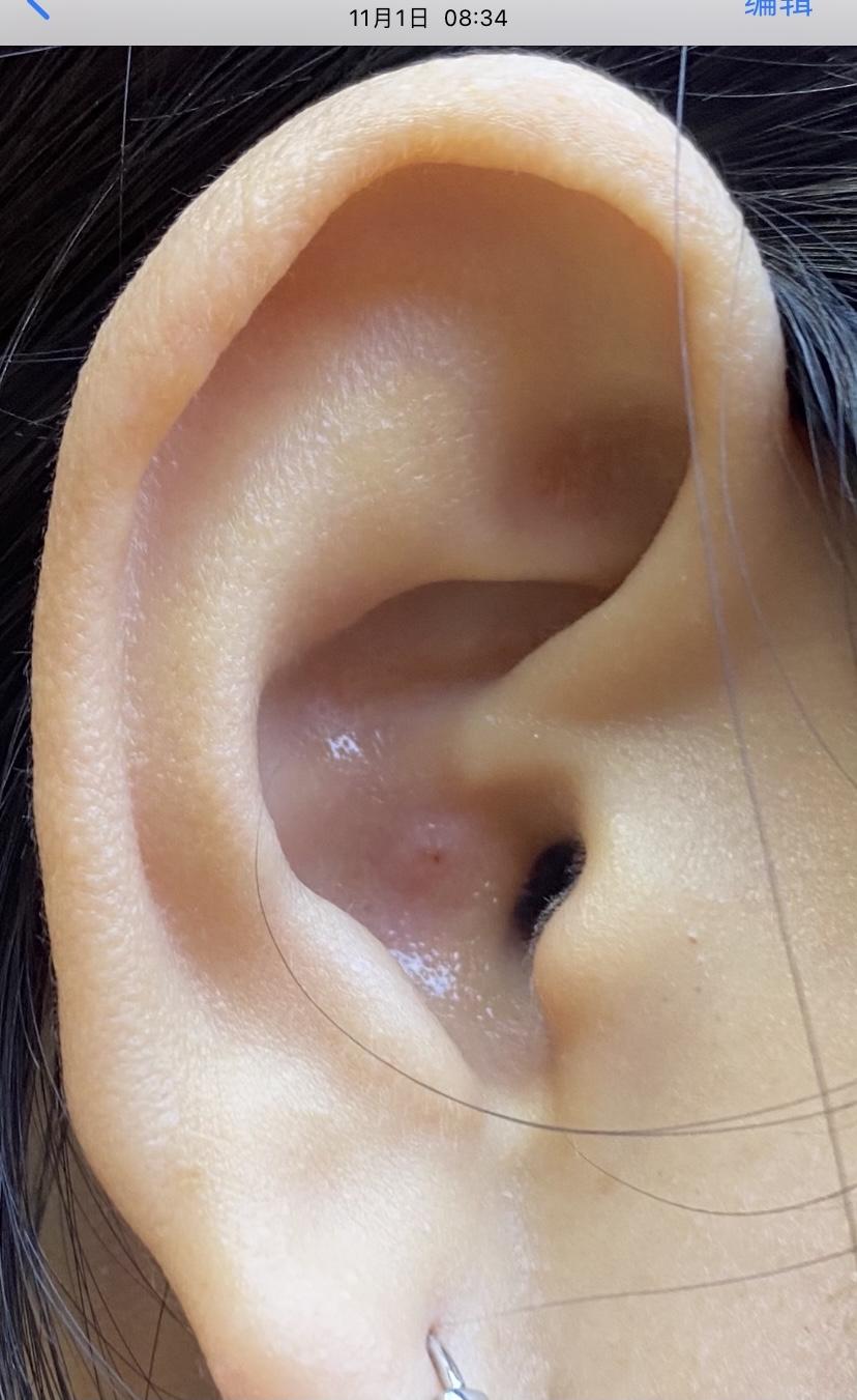 怎样对付外耳道的疖肿? - 知乎